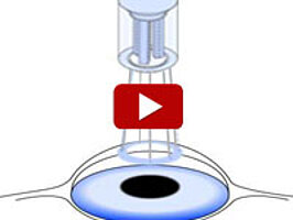 Watch how piezo mirrors direct laser beams for eye surgery